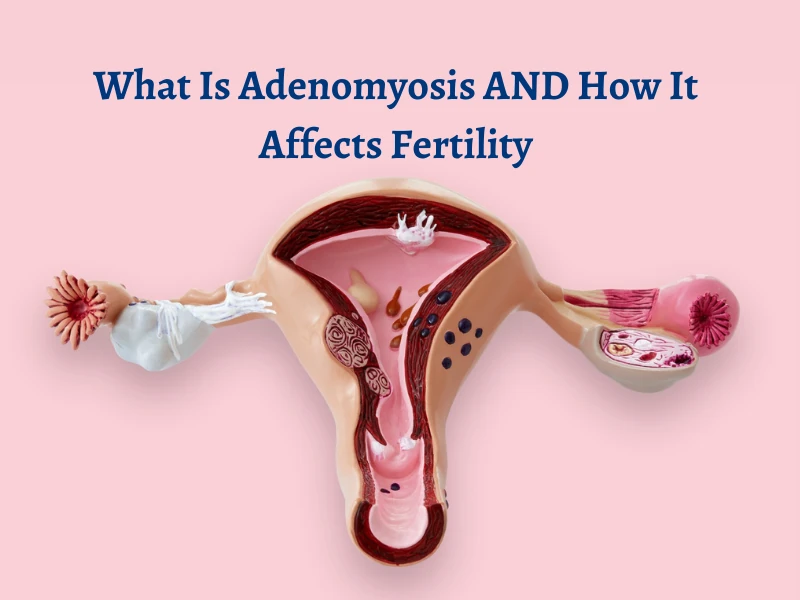 What Is Adenomyosis And How It Affects Fertility